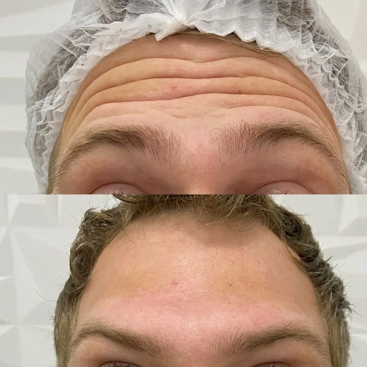 Imagem de antes e depois do tratamento estético com toxina botulínica na região frontal, demonstrando a diminuição das linhas de expressão na face.