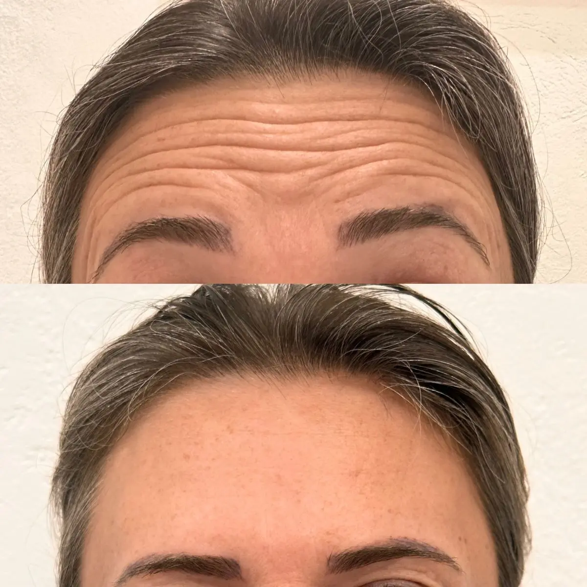 Imagem de antes e depois focada na região da testa após a aplicação de toxina botulínica, demonstrando o relaxamento das linhas faciais.