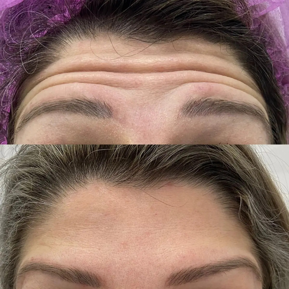 Registro clínico de antes e depois da aplicação de toxina botulínica focada na região da glabela e testa, demonstrando a suavização da pele em movimento.