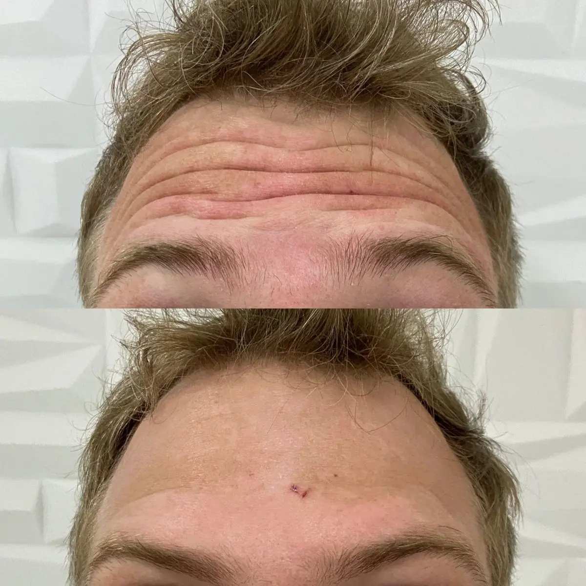 Resultado comparativo de aplicação de toxina botulínica na região frontal da face, demonstrando a suavização de linhas de expressão dinâmicas.