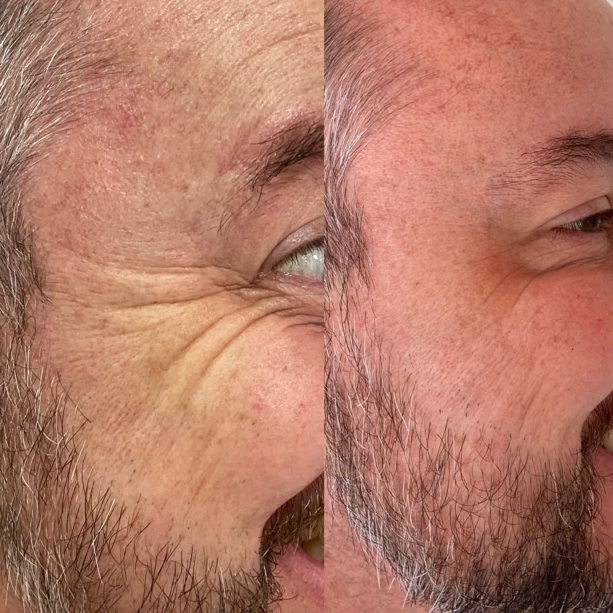 Detalhe de antes e depois do tratamento com toxina botulínica na região periocular, mostrando o relaxamento muscular durante a expressão facial.