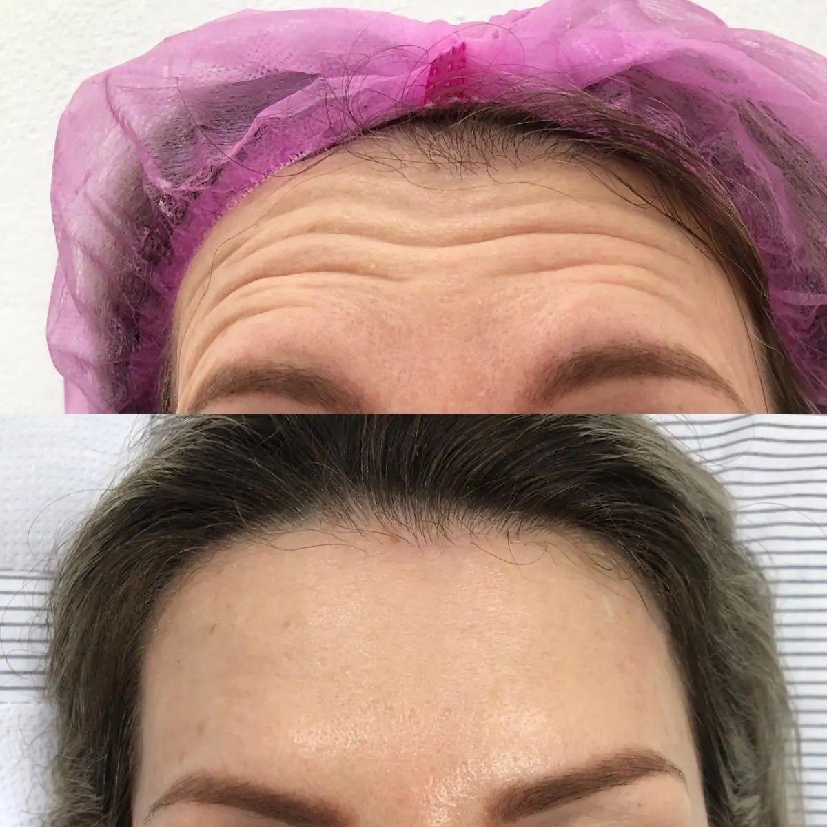 Avaliação visual de antes e depois da utilização de toxina botulínica para o gerenciamento de rugas dinâmicas na região superior da face.