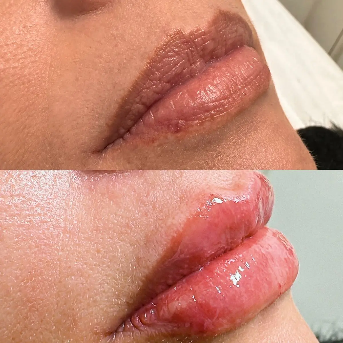 Comparativo de antes e depois da aplicação de ácido hialurônico nos lábios, mostrando ganho de volume sutil e melhora do contorno.