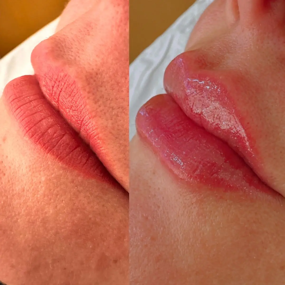 Resultado de harmonização labial em perfil, evidenciando a eversão do lábio superior sem o indesejado efeito exagerado.