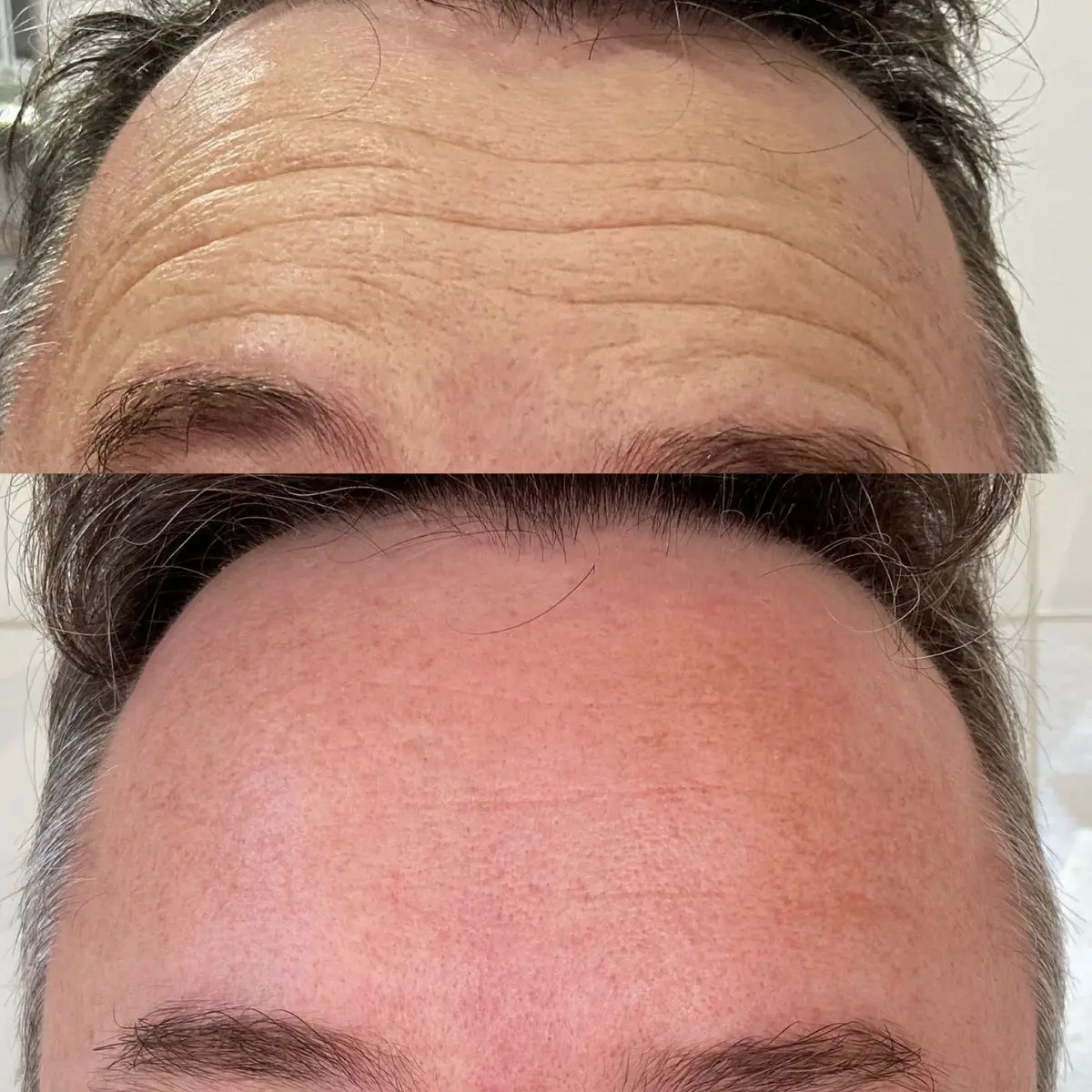 Detalhe facial comparativo de antes e depois da aplicação de toxina botulínica para o gerenciamento de linhas de expressão na região frontal superior.
