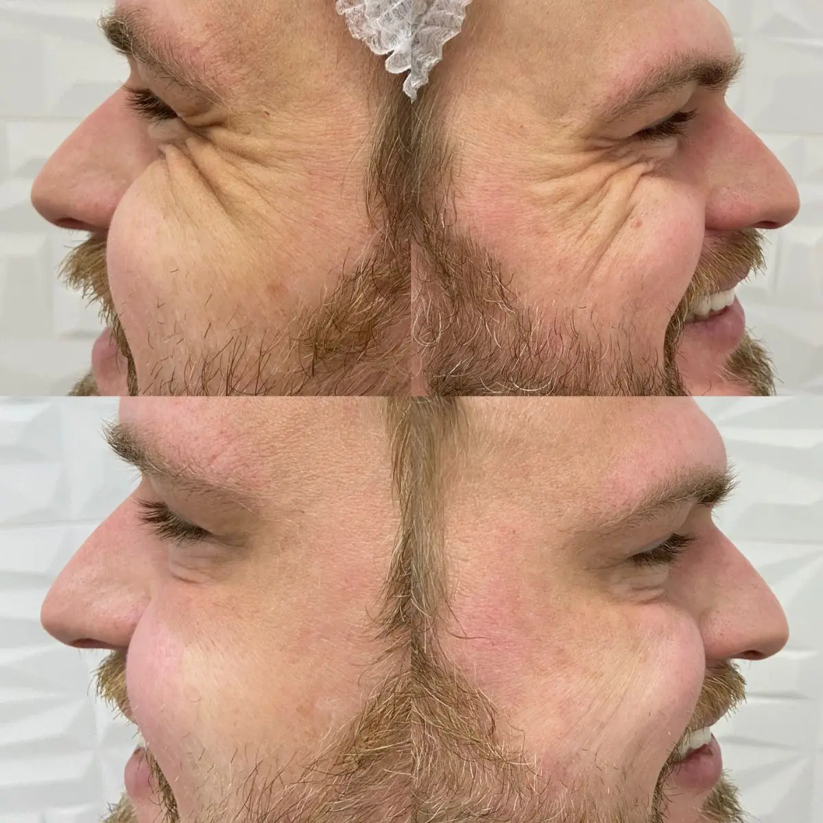 Comparativo clínico de antes e depois da aplicação de toxina botulínica na região periocular, evidenciando a suavização das linhas dinâmicas durante a expressão facial.