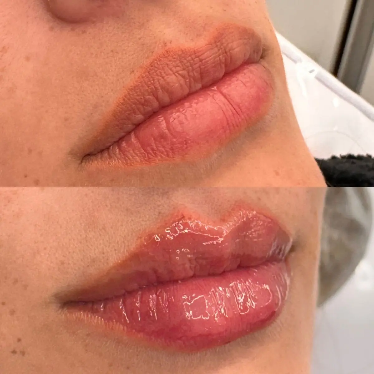 Detalhe do aumento de hidratação labial e devolução de viço após o procedimento injetável.