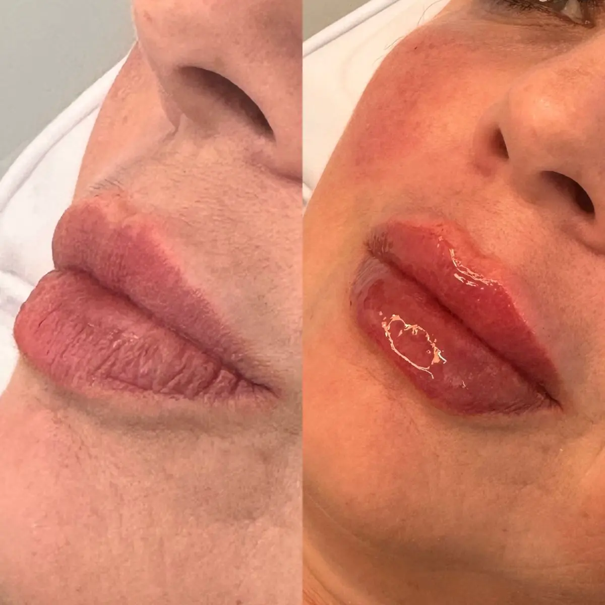 Imagem comparativa focada na naturalidade do procedimento labial, mantendo as proporções originais do rosto da paciente.